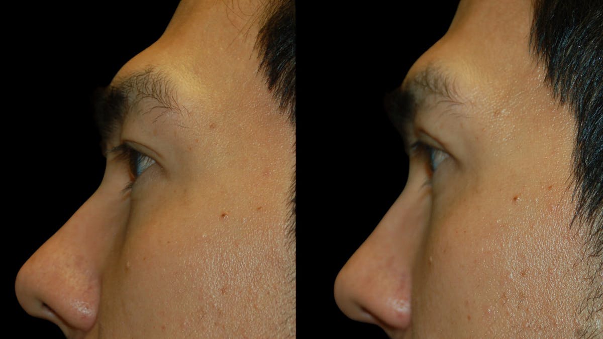 Upper Eyelid Surgery Before & After Gallery - Patient 182517 - Image 6