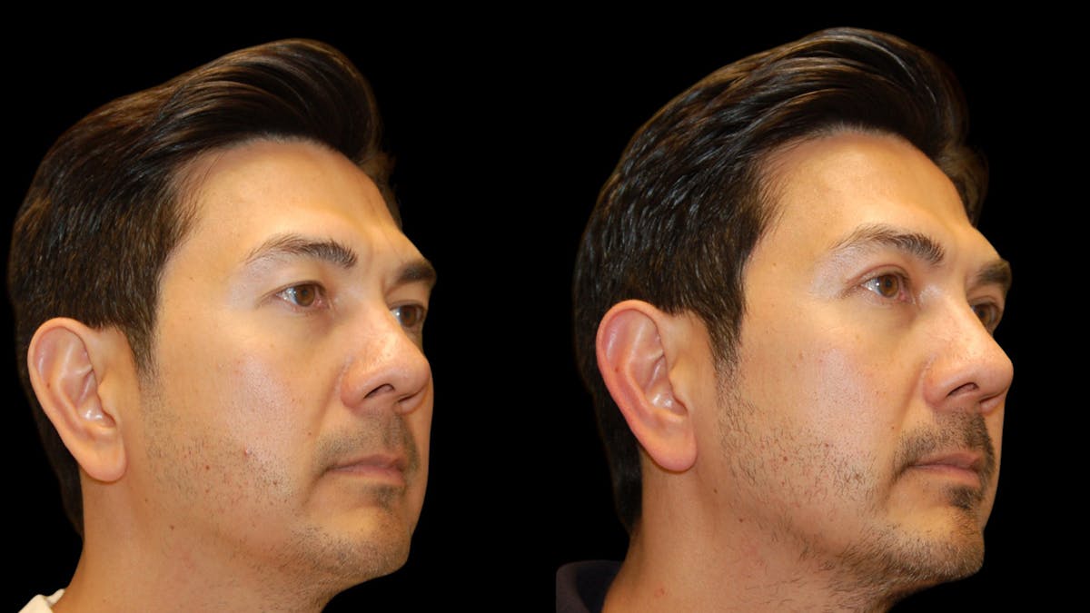 Upper Eyelid Surgery Before & After Gallery - Patient 182517 - Image 7