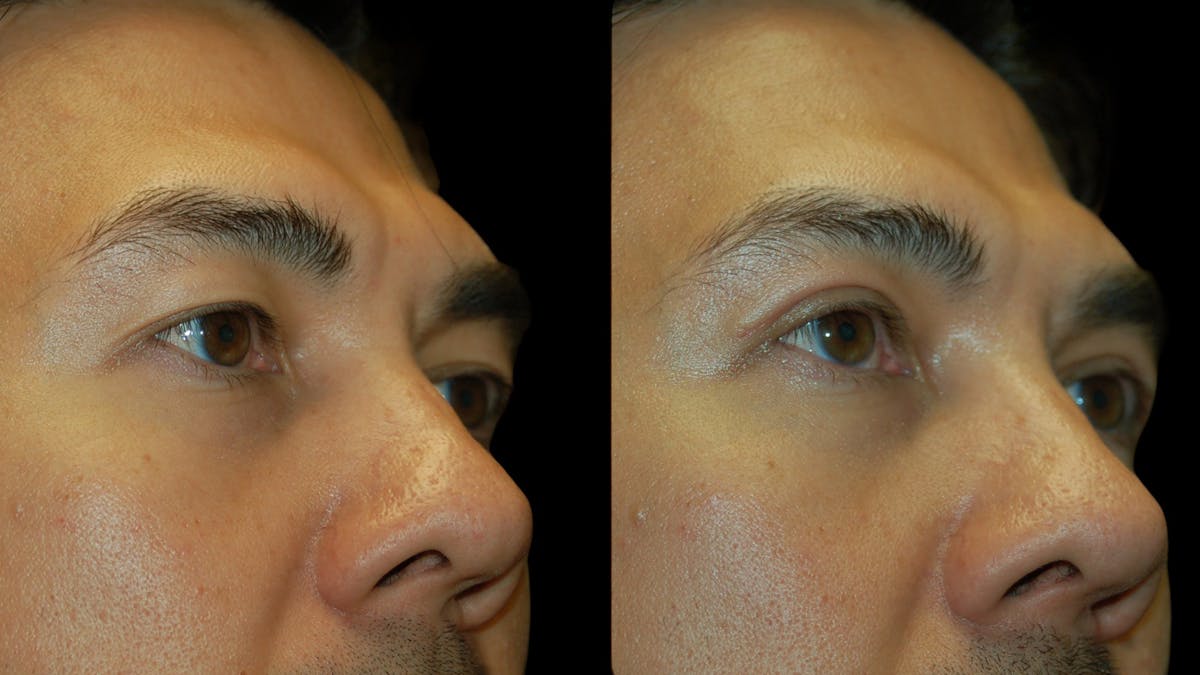 Upper Eyelid Surgery Before & After Gallery - Patient 182517 - Image 8
