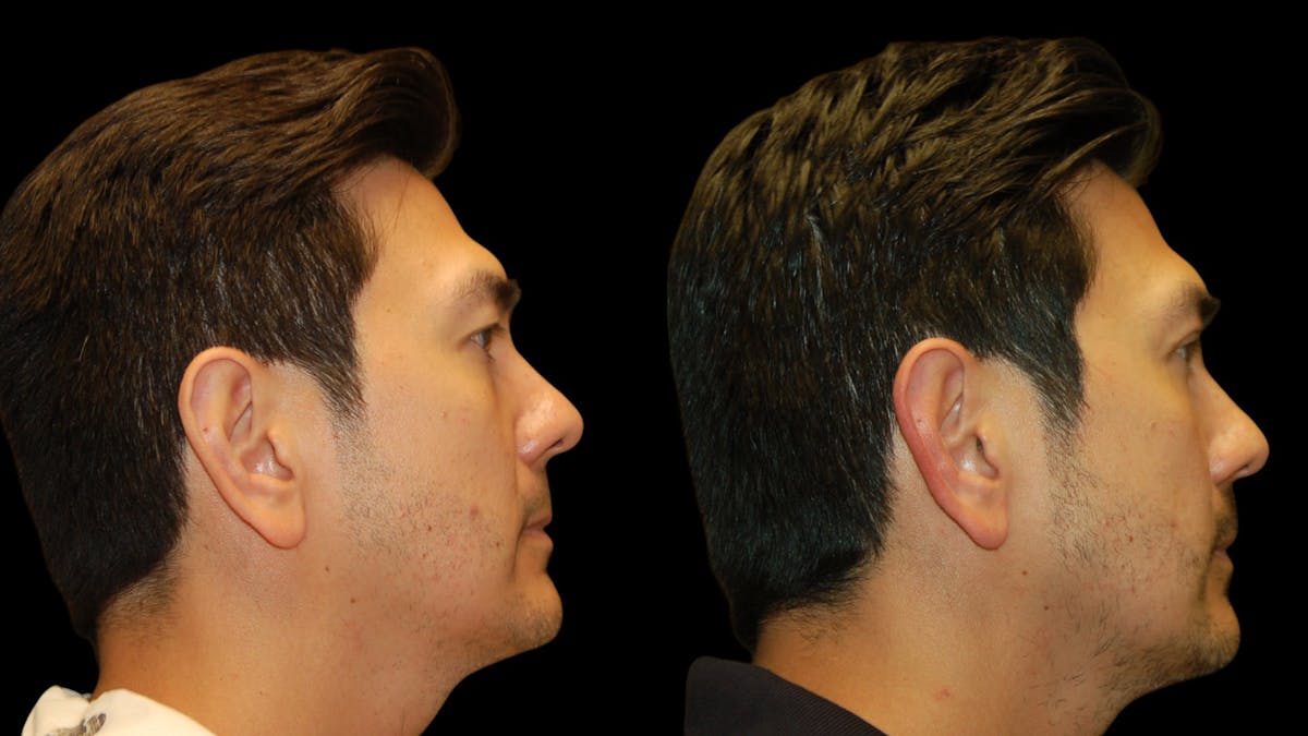 Upper Eyelid Surgery Before & After Gallery - Patient 182517 - Image 9