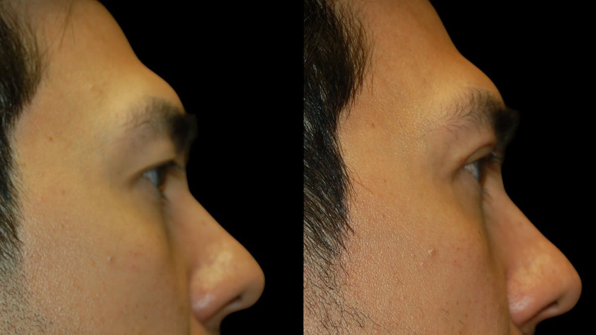 Upper Eyelid Surgery Before & After Gallery - Patient 182517 - Image 10