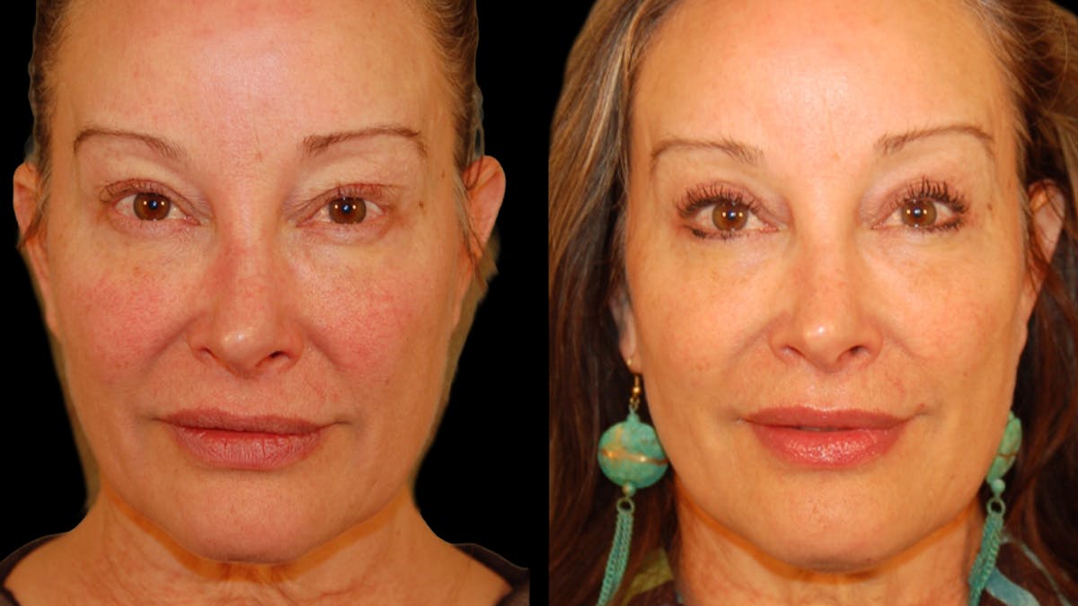 Upper Eyelid Surgery Before & After Gallery - Patient 537030 - Image 1