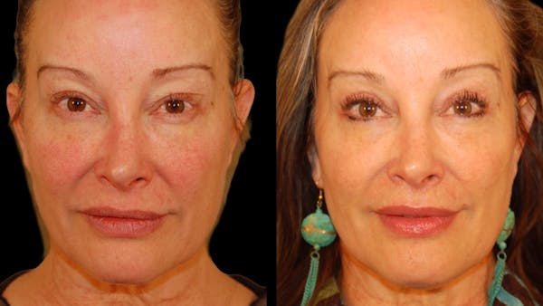 Upper Eyelid Surgery Before & After Gallery - Patient 537030 - Image 1