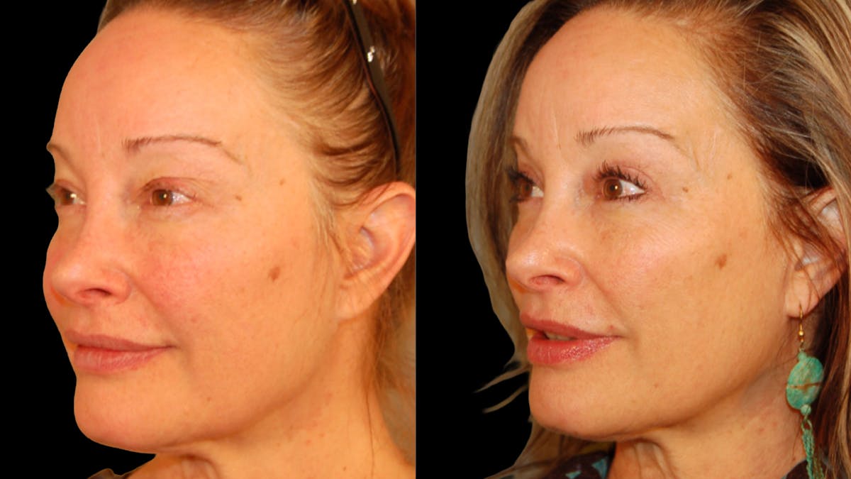 Upper Eyelid Surgery Before & After Gallery - Patient 537030 - Image 2
