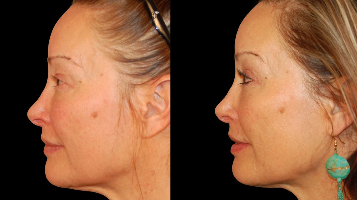 Upper Eyelid Surgery Before & After Gallery - Patient 537030 - Image 3