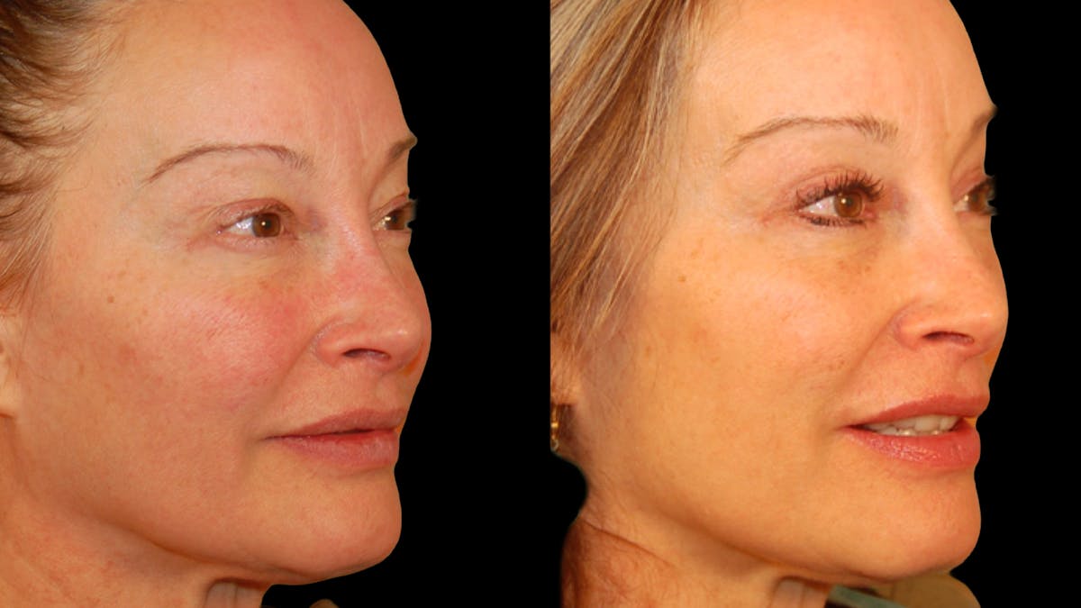 Upper Eyelid Surgery Before & After Gallery - Patient 537030 - Image 4