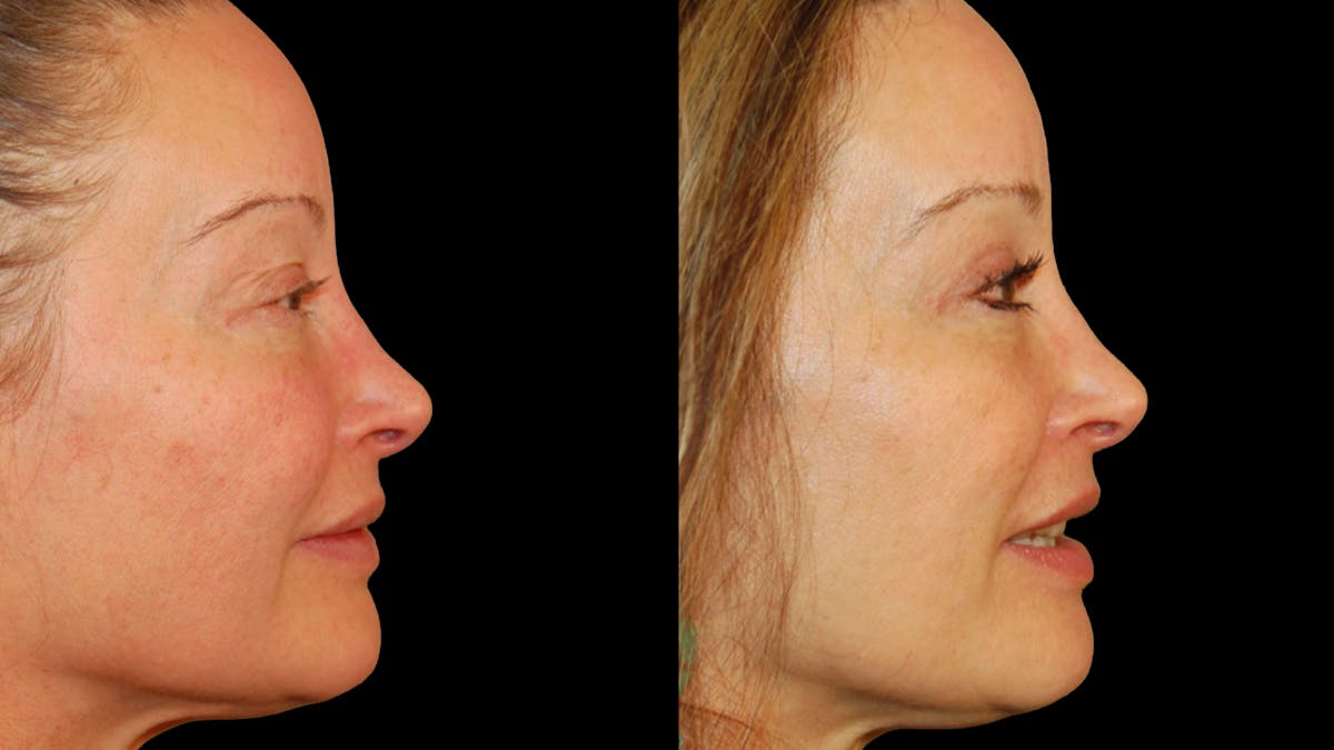 Upper Eyelid Surgery Before & After Gallery - Patient 537030 - Image 5
