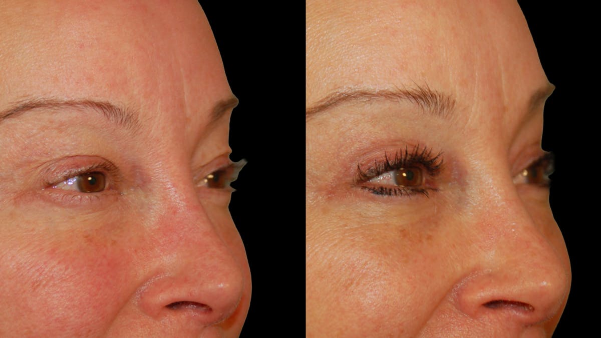 Upper Eyelid Surgery Before & After Gallery - Patient 537030 - Image 6