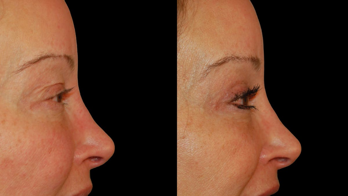 Upper Eyelid Surgery Before & After Gallery - Patient 537030 - Image 7
