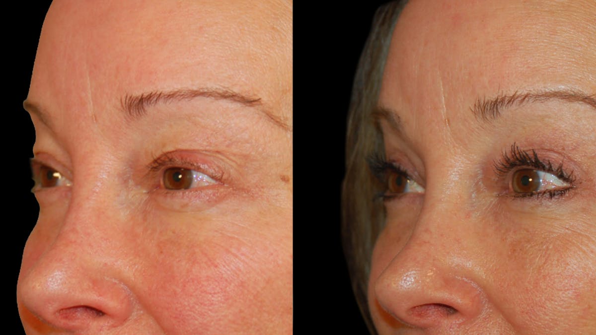 Upper Eyelid Surgery Before & After Gallery - Patient 537030 - Image 8