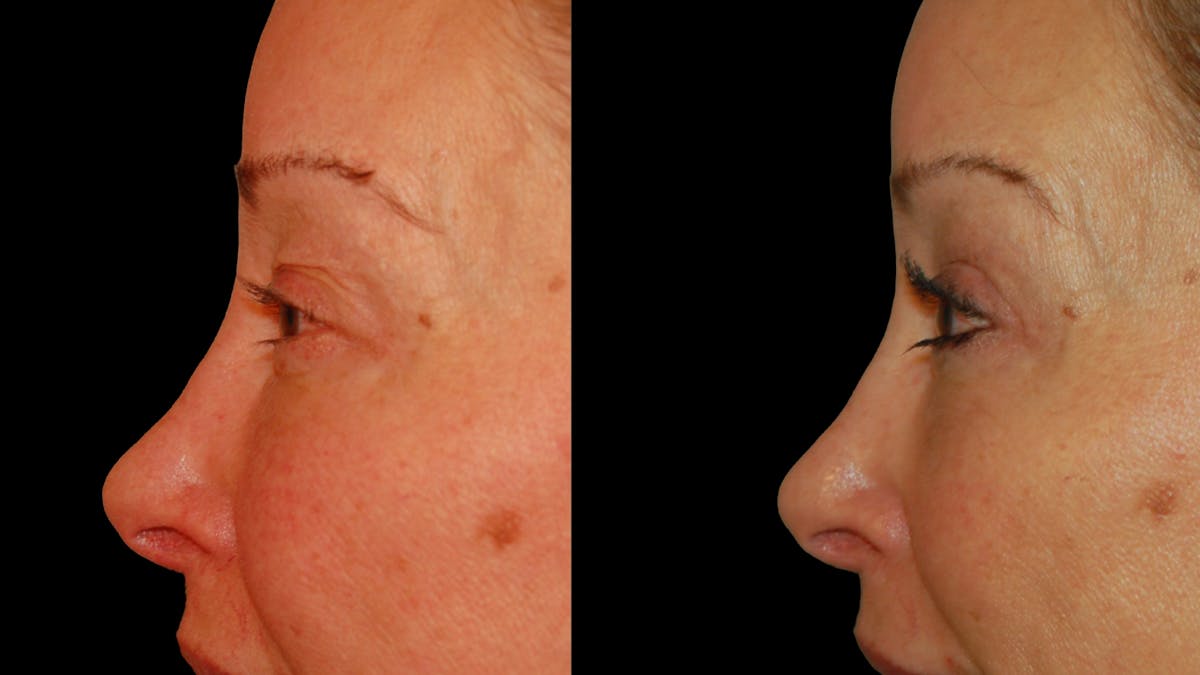 Upper Eyelid Surgery Before & After Gallery - Patient 537030 - Image 9