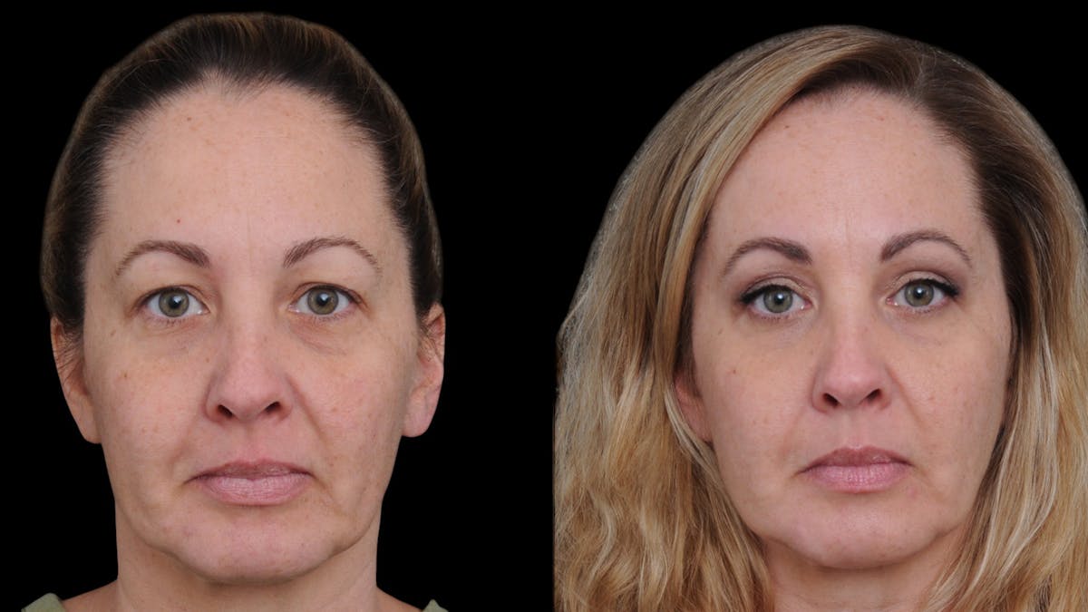 Upper Eyelid Surgery Before & After Gallery - Patient 730584 - Image 1