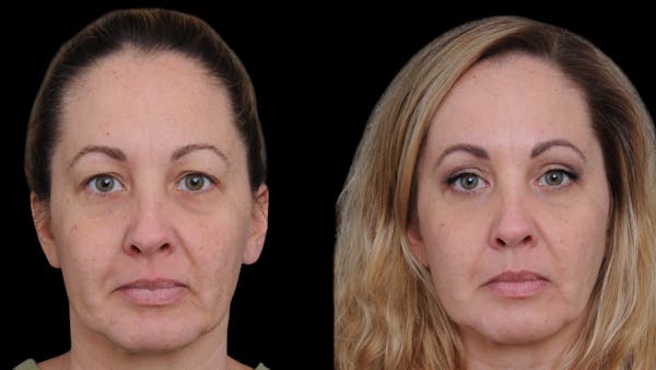Upper Eyelid Surgery Before & After Gallery - Patient 730584 - Image 1