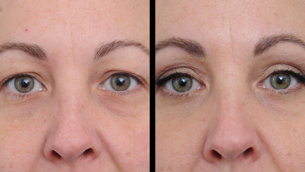 Upper Eyelid Surgery Before & After Gallery - Patient 730584 - Image 2