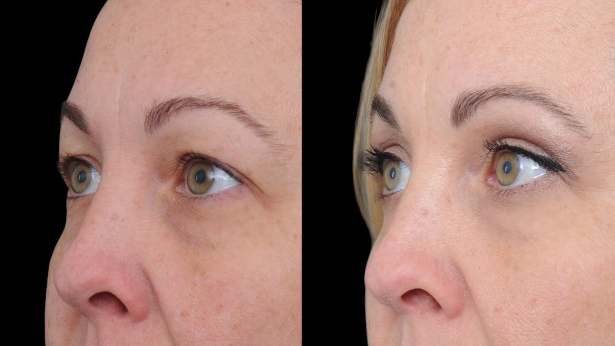 Upper Eyelid Surgery Before & After Gallery - Patient 730584 - Image 3