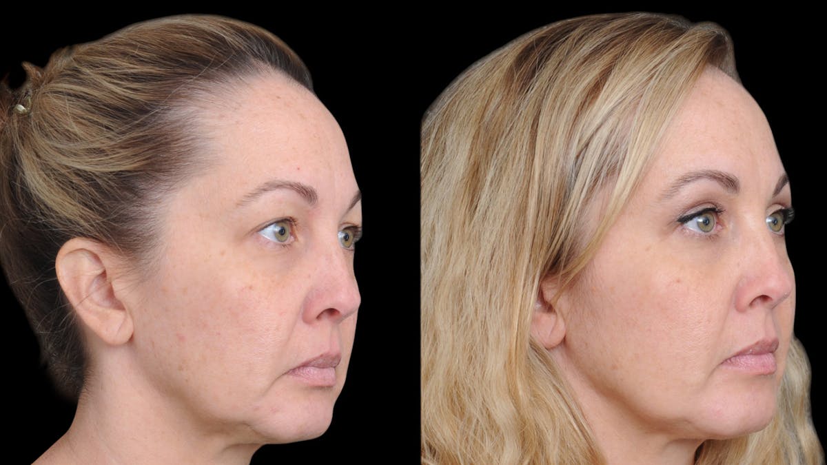 Upper Eyelid Surgery Before & After Gallery - Patient 730584 - Image 4