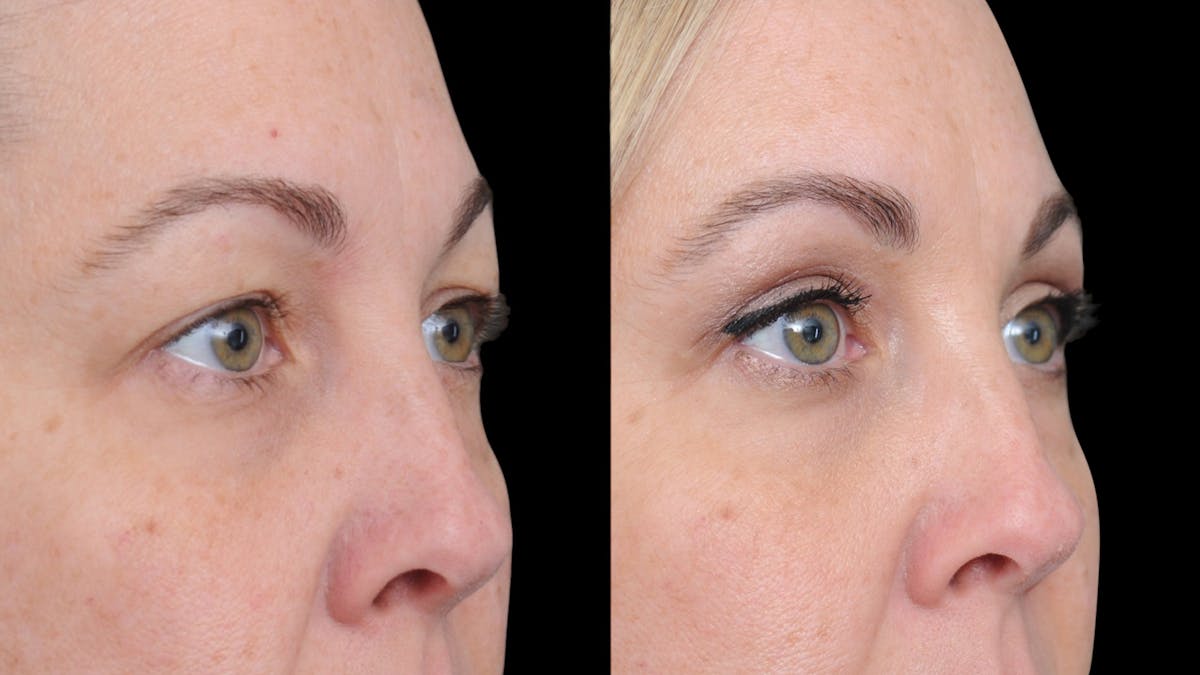 Upper Eyelid Surgery Before & After Gallery - Patient 730584 - Image 5