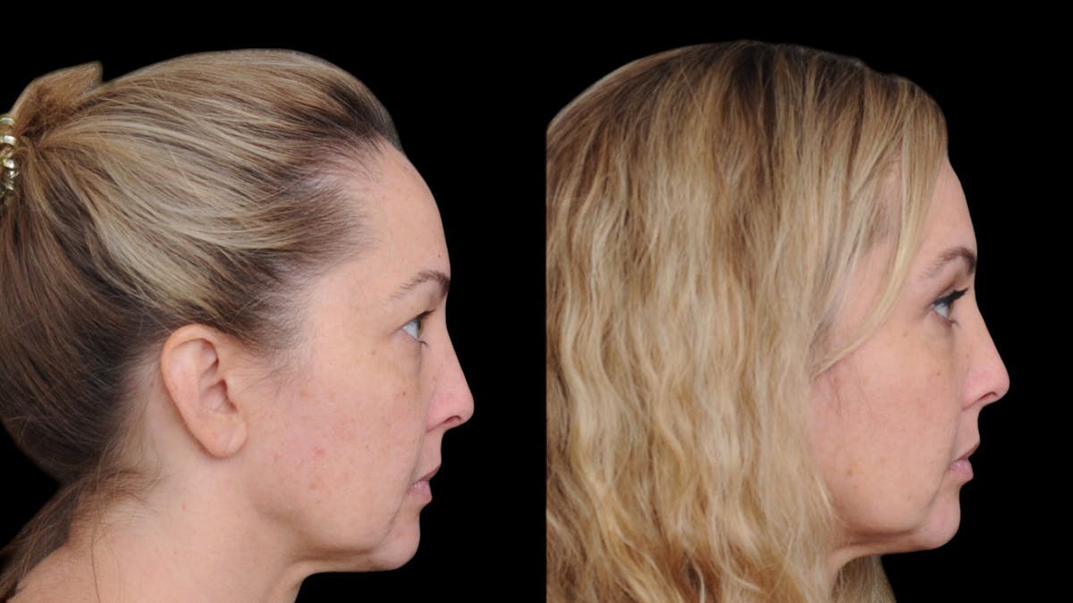 Upper Eyelid Surgery Before & After Gallery - Patient 730584 - Image 6