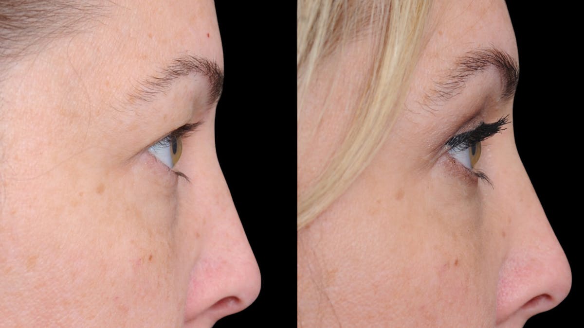 Upper Eyelid Surgery Before & After Gallery - Patient 730584 - Image 7