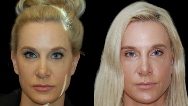 Upper Eyelid Surgery Before & After Gallery - Patient 185113 - Image 1