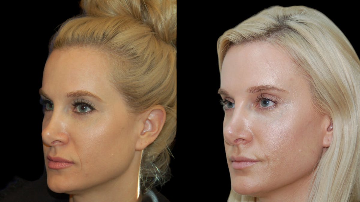 Upper Eyelid Surgery Before & After Gallery - Patient 185113 - Image 2