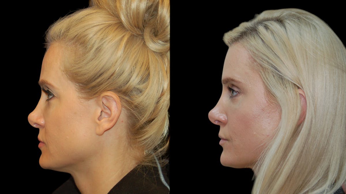 Upper Eyelid Surgery Before & After Gallery - Patient 185113 - Image 3