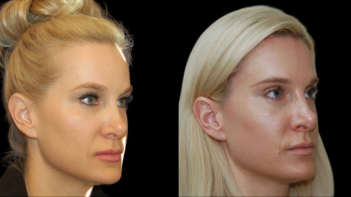 Upper Eyelid Surgery Before & After Gallery - Patient 185113 - Image 4