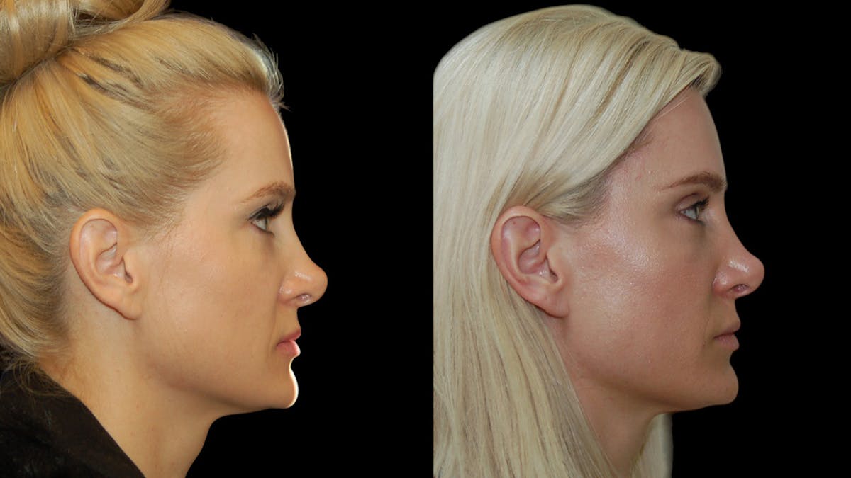 Upper Eyelid Surgery Before & After Gallery - Patient 185113 - Image 5