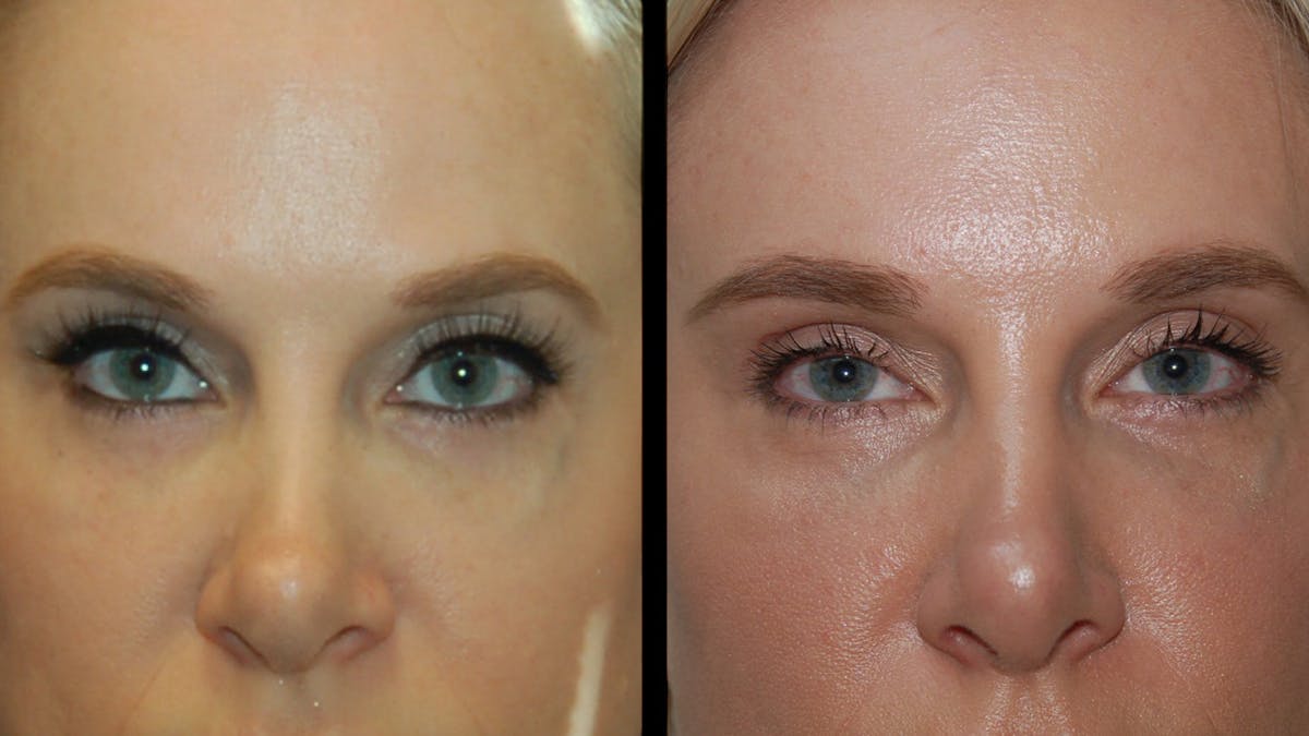 Upper Eyelid Surgery Before & After Gallery - Patient 185113 - Image 6