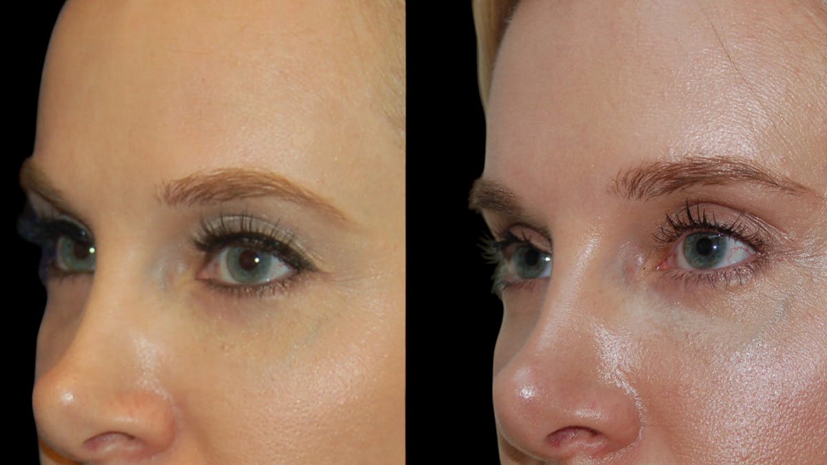Upper Eyelid Surgery Before & After Gallery - Patient 185113 - Image 7