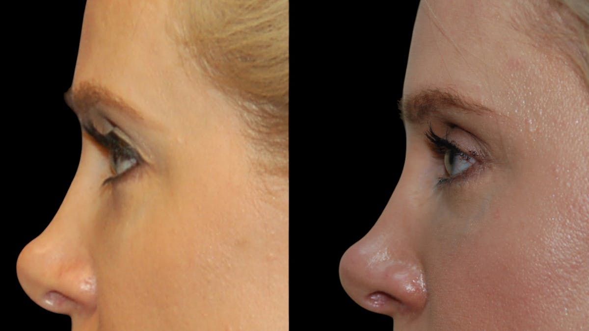 Upper Eyelid Surgery Before & After Gallery - Patient 185113 - Image 8