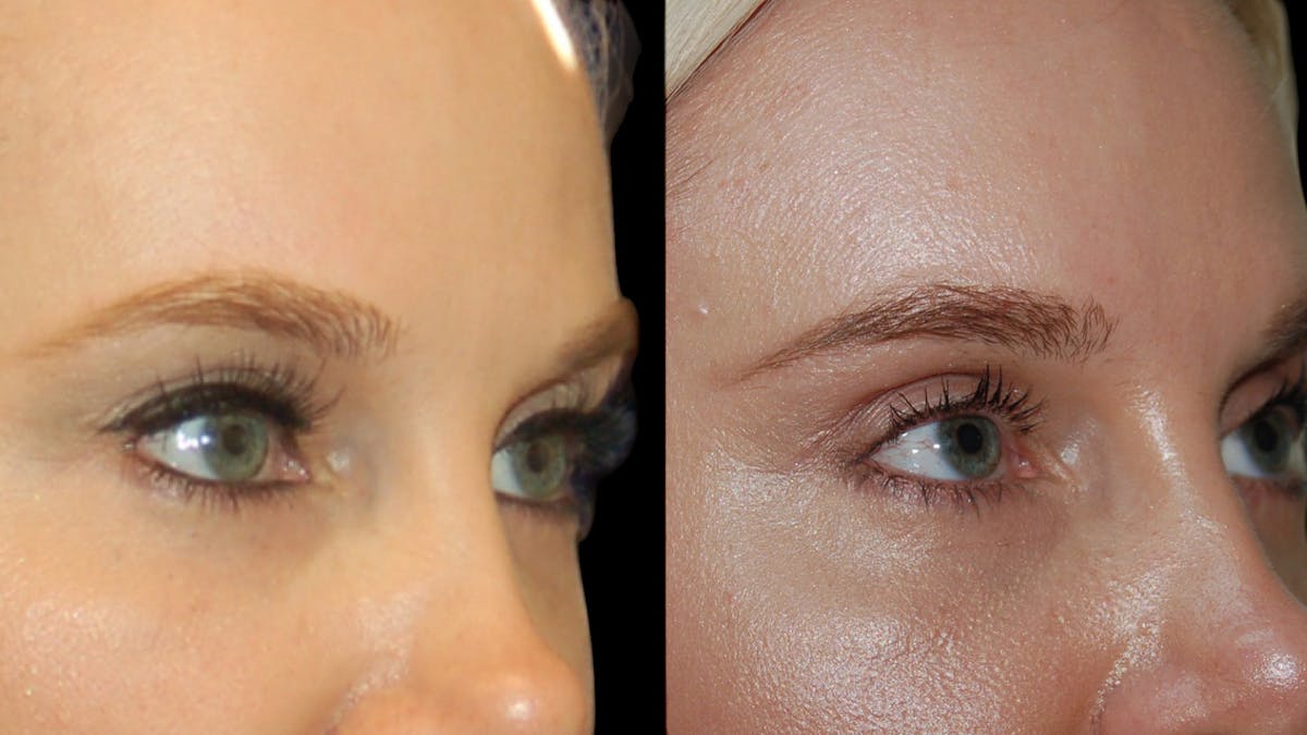 Upper Eyelid Surgery Before & After Gallery - Patient 185113 - Image 9