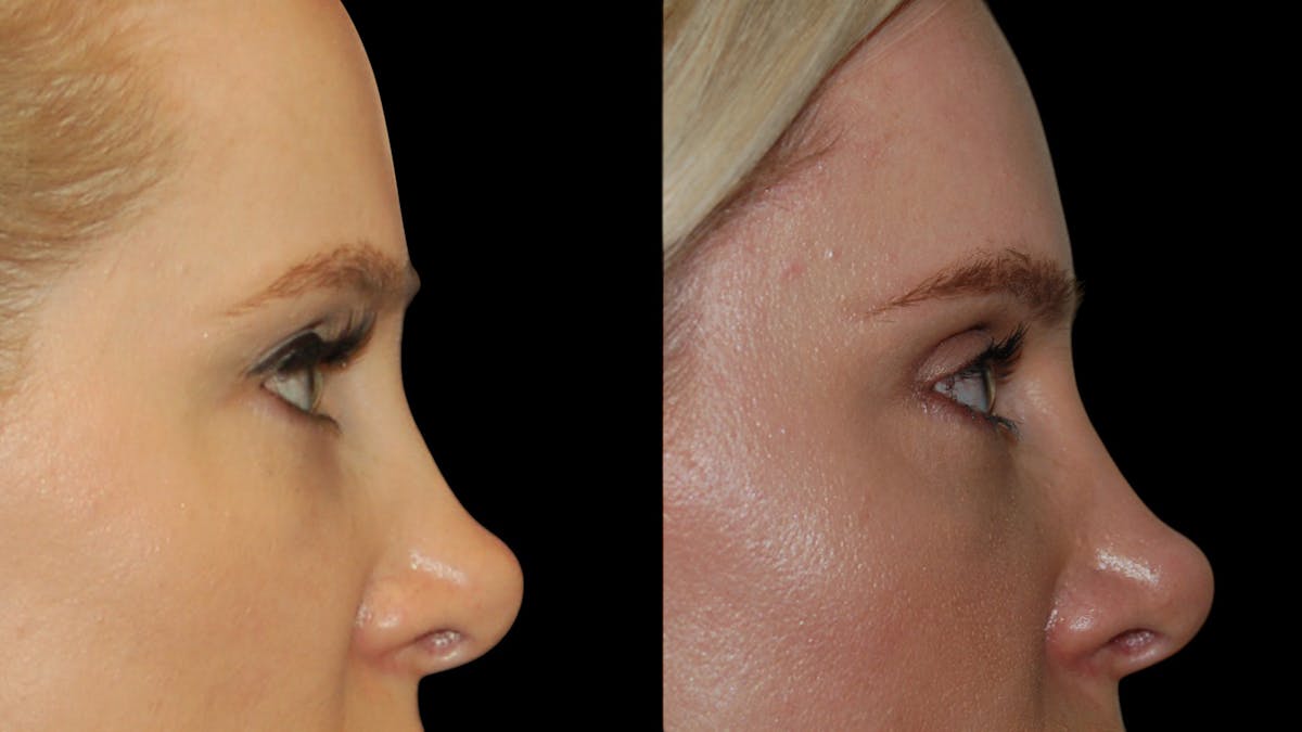 Upper Eyelid Surgery Before & After Gallery - Patient 185113 - Image 10