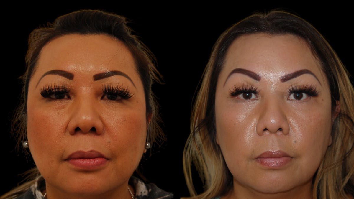 Upper Eyelid Surgery Before & After Gallery - Patient 248258 - Image 1