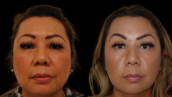 Upper Eyelid Surgery Before & After Gallery - Patient 248258 - Image 1