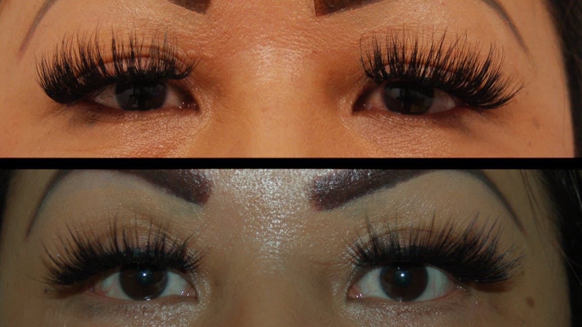 Upper Eyelid Surgery Before & After Gallery - Patient 248258 - Image 2