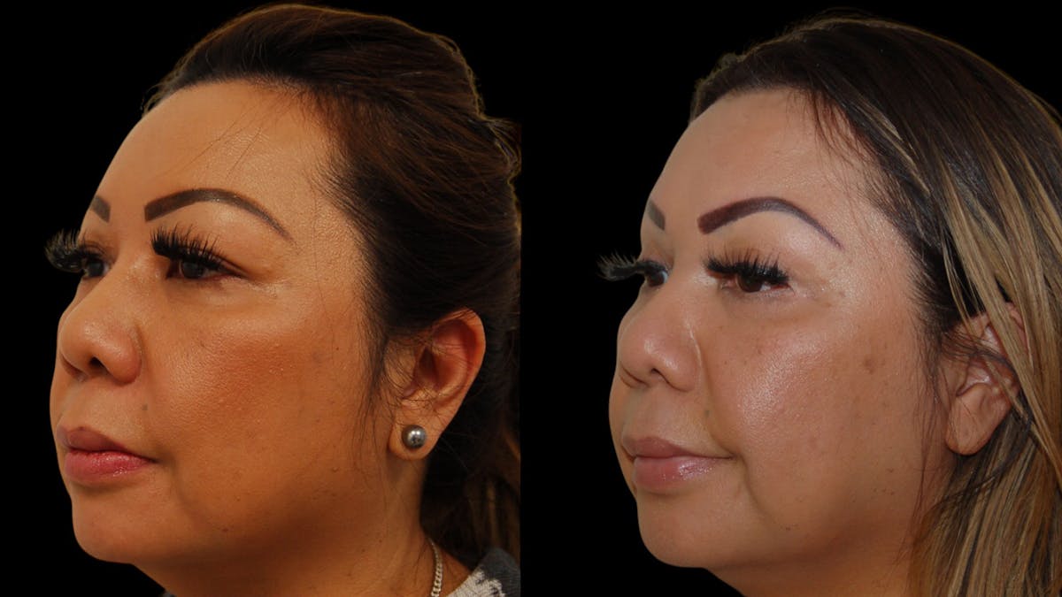 Upper Eyelid Surgery Before & After Gallery - Patient 248258 - Image 3