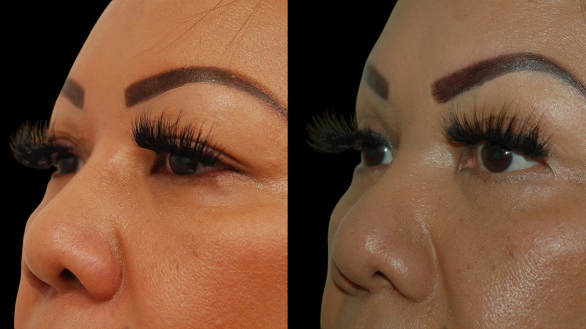 Upper Eyelid Surgery Before & After Gallery - Patient 248258 - Image 4
