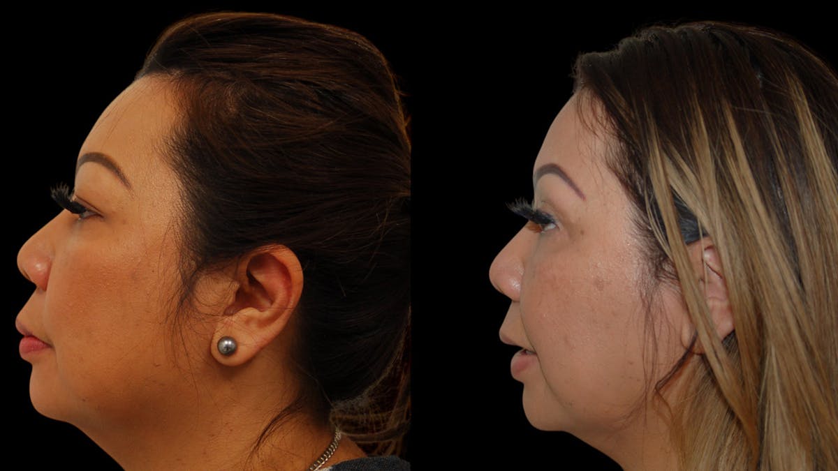 Upper Eyelid Surgery Before & After Gallery - Patient 248258 - Image 5