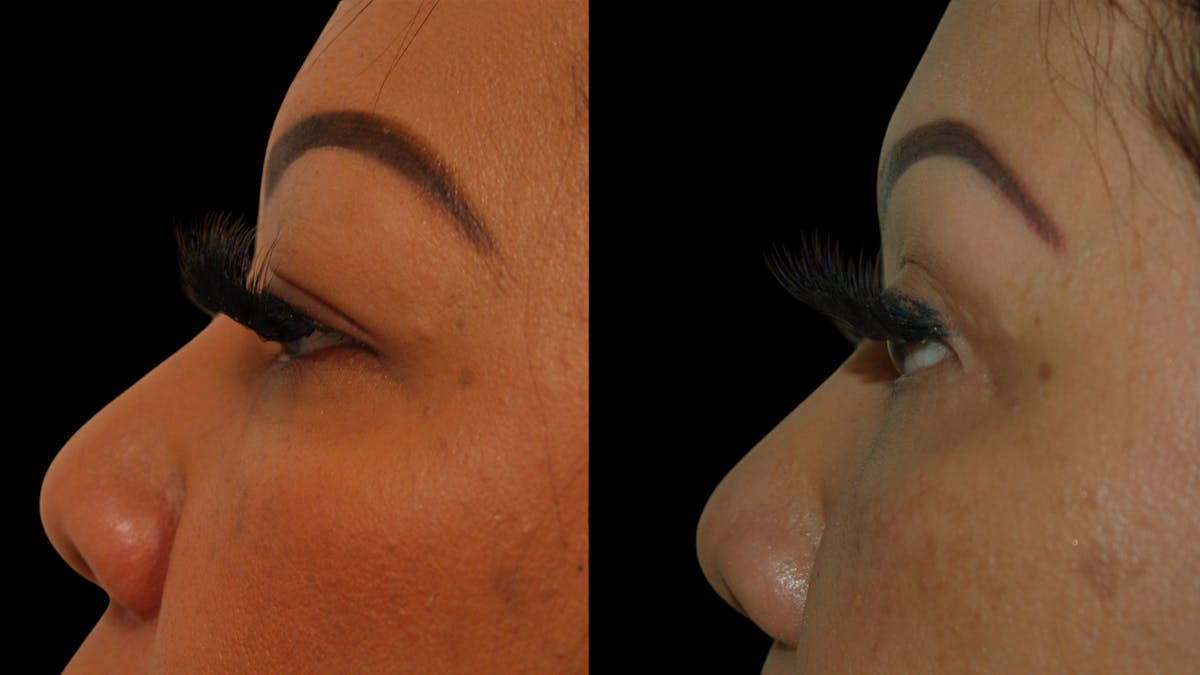 Upper Eyelid Surgery Before & After Gallery - Patient 248258 - Image 6