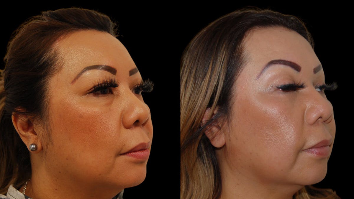 Upper Eyelid Surgery Before & After Gallery - Patient 248258 - Image 7