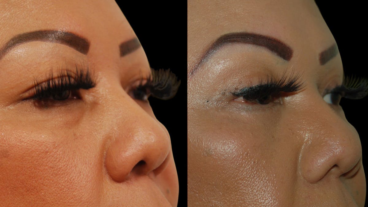 Upper Eyelid Surgery Before & After Gallery - Patient 248258 - Image 8
