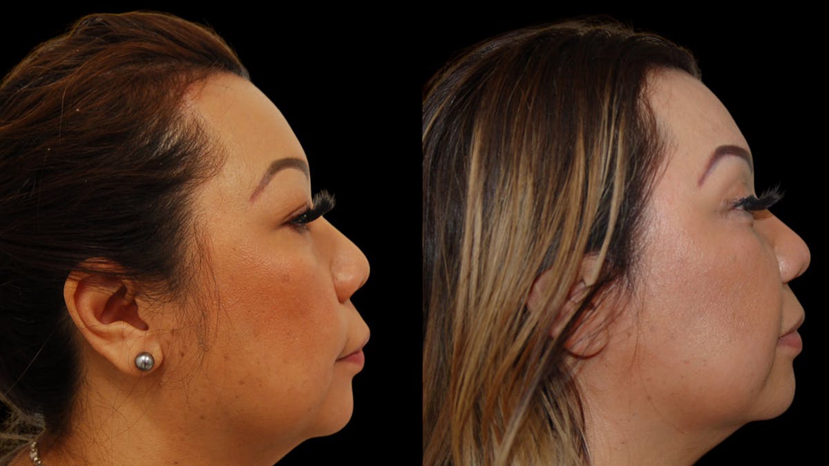 Upper Eyelid Surgery Before & After Gallery - Patient 248258 - Image 9