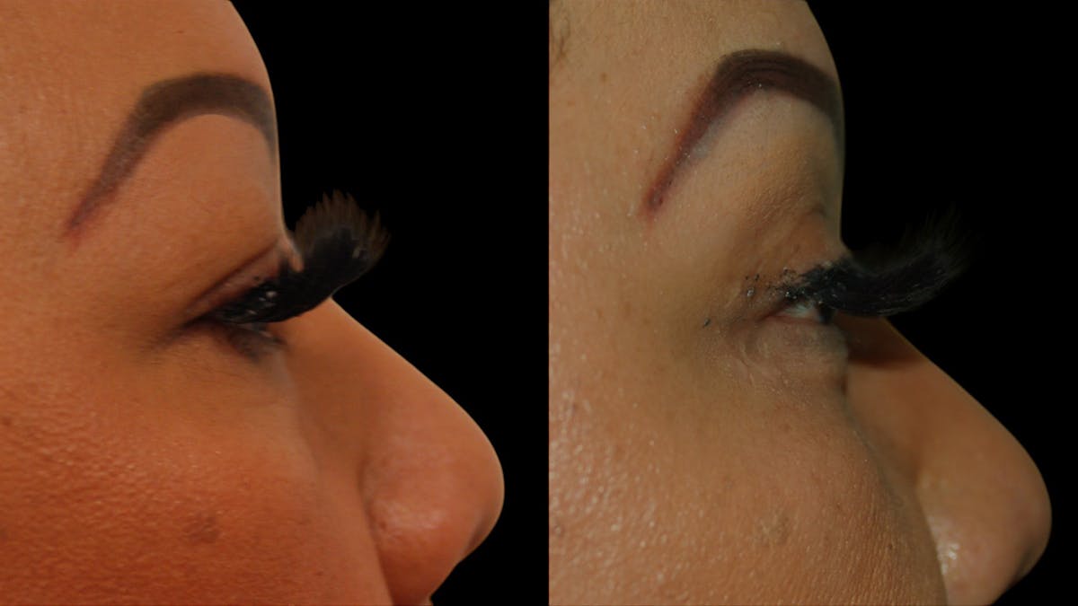 Upper Eyelid Surgery Before & After Gallery - Patient 248258 - Image 10