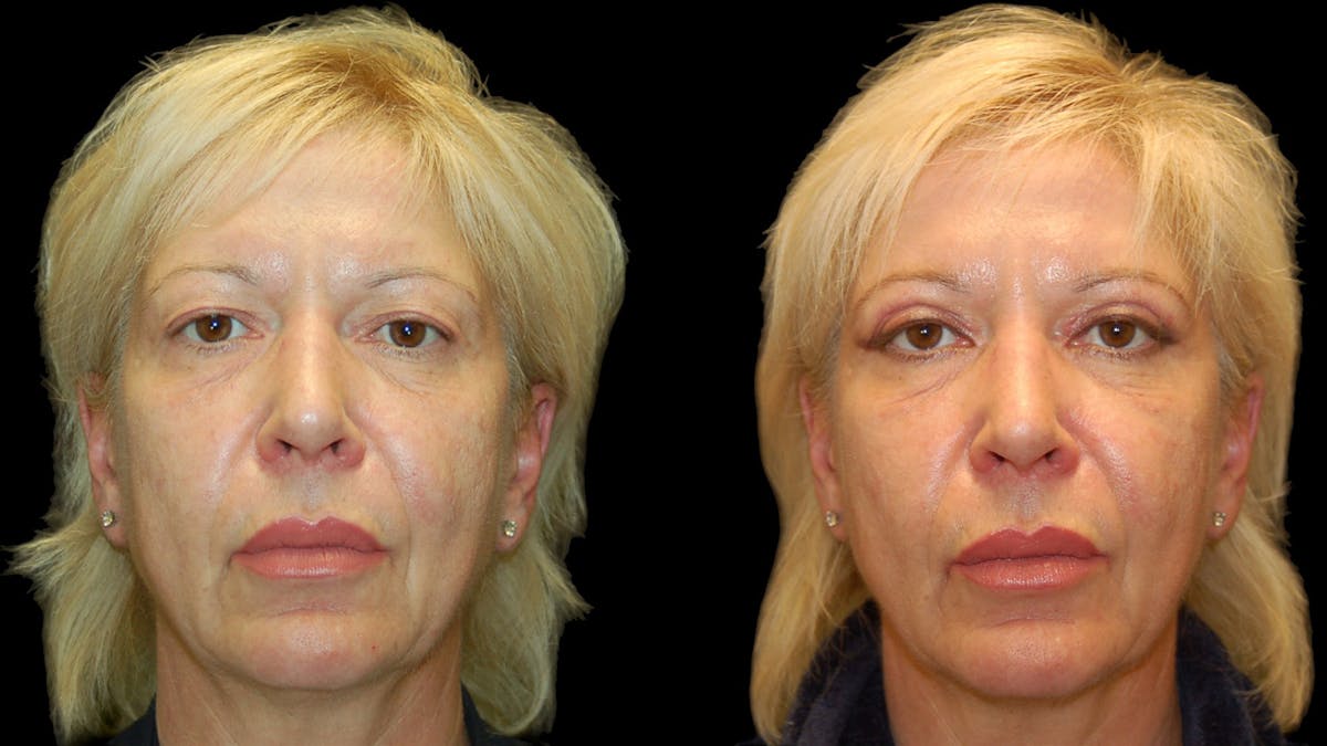 Upper Eyelid Surgery Before & After Gallery - Patient 312629 - Image 1