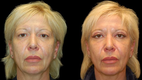 Upper Eyelid Surgery Before & After Gallery - Patient 312629 - Image 1