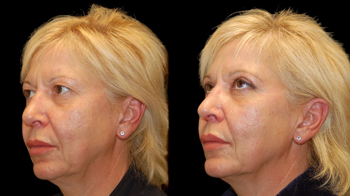 Upper Eyelid Surgery Before & After Gallery - Patient 312629 - Image 2