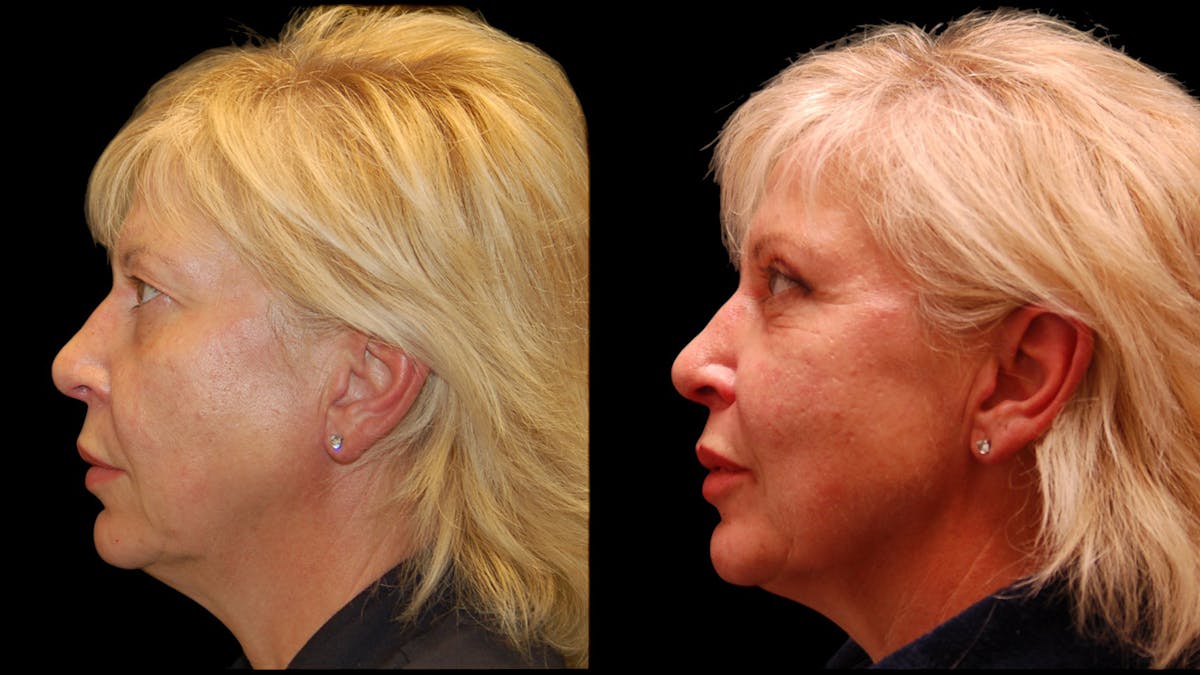 Upper Eyelid Surgery Before & After Gallery - Patient 312629 - Image 3