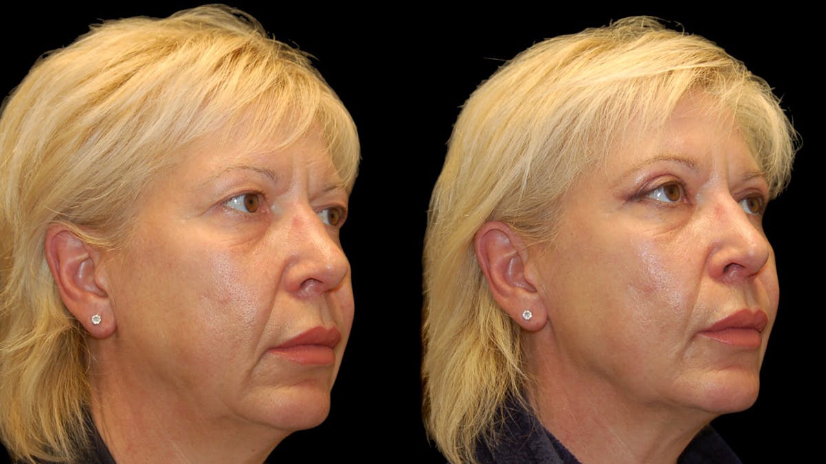 Upper Eyelid Surgery Before & After Gallery - Patient 312629 - Image 4