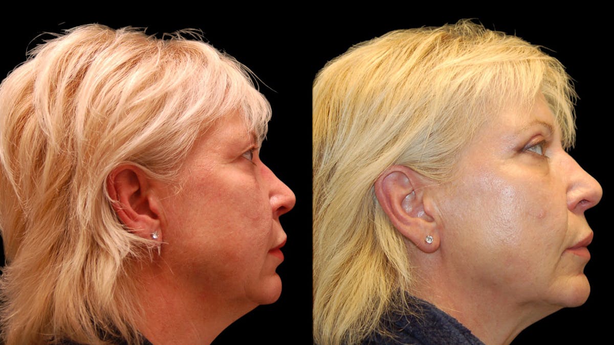 Upper Eyelid Surgery Before & After Gallery - Patient 312629 - Image 5